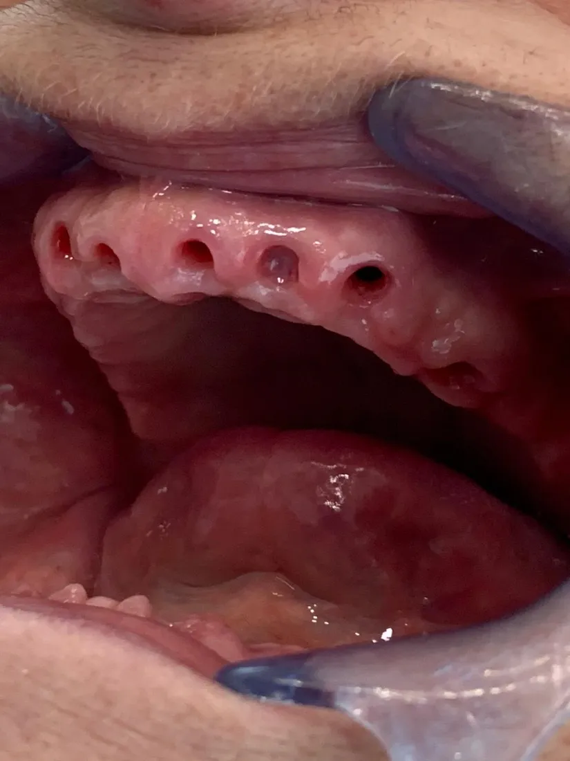 Eingeheilte Implantate im Oberkiefer