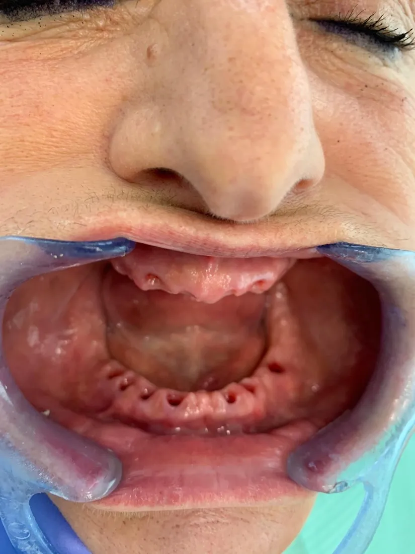 Eingeheilte Implantate im Ober- und Unterkiefer, bereit für den Zahnersatz