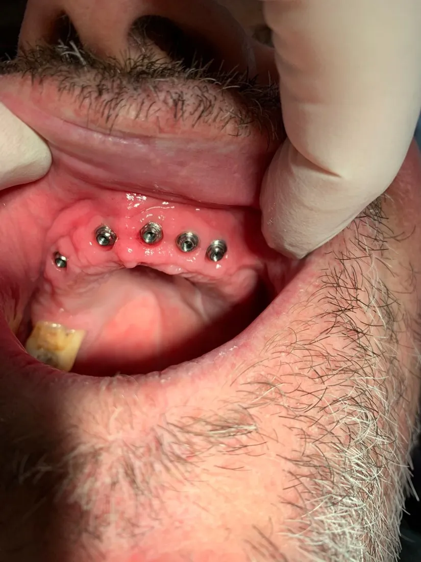 Eingeheilte Implantate im Oberkiefer