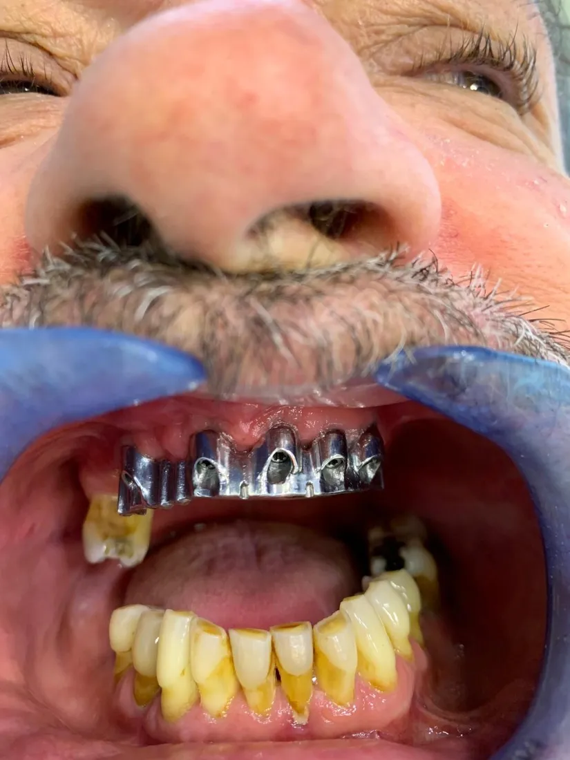 Ein Steg verbindet die Implantate im Oberkiefer