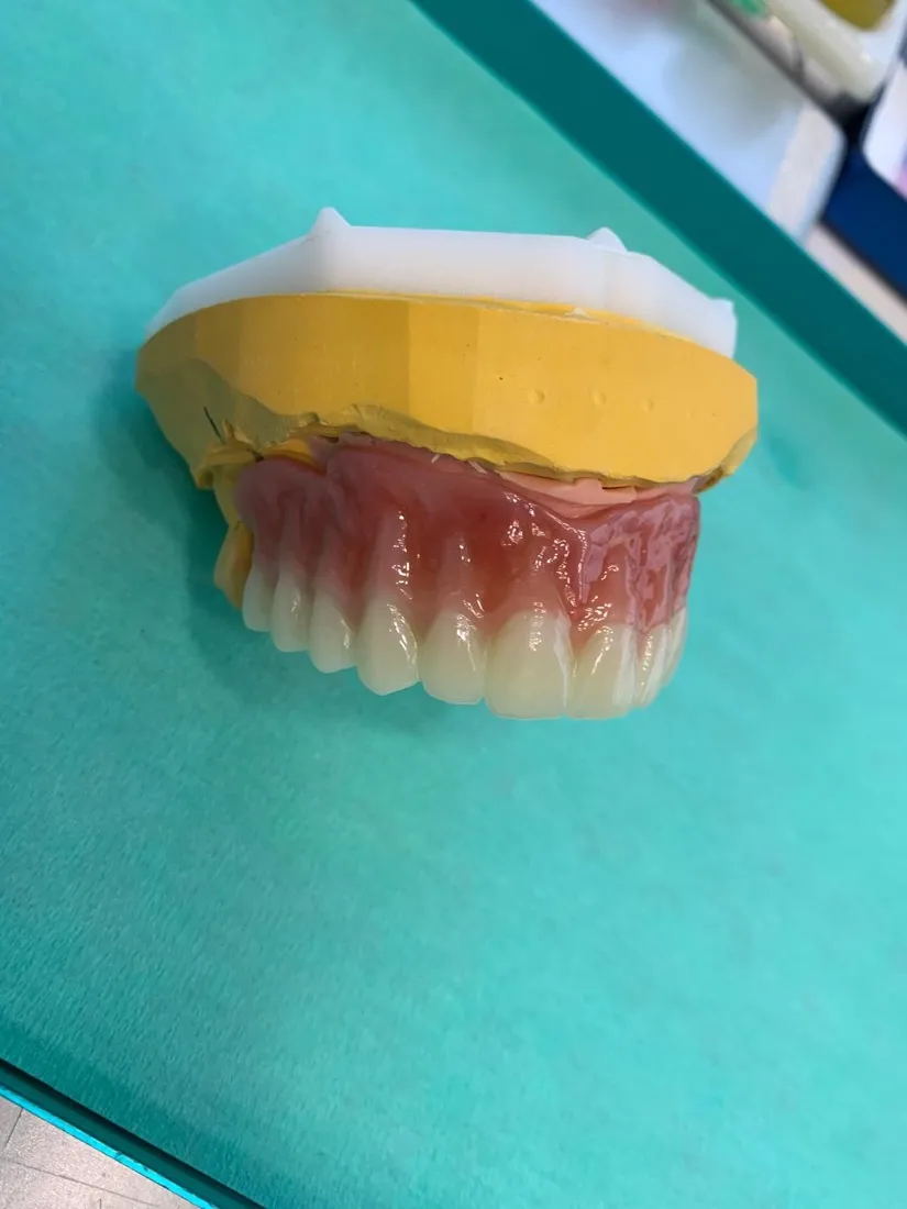 Die fertige Prothese auf dem Modell