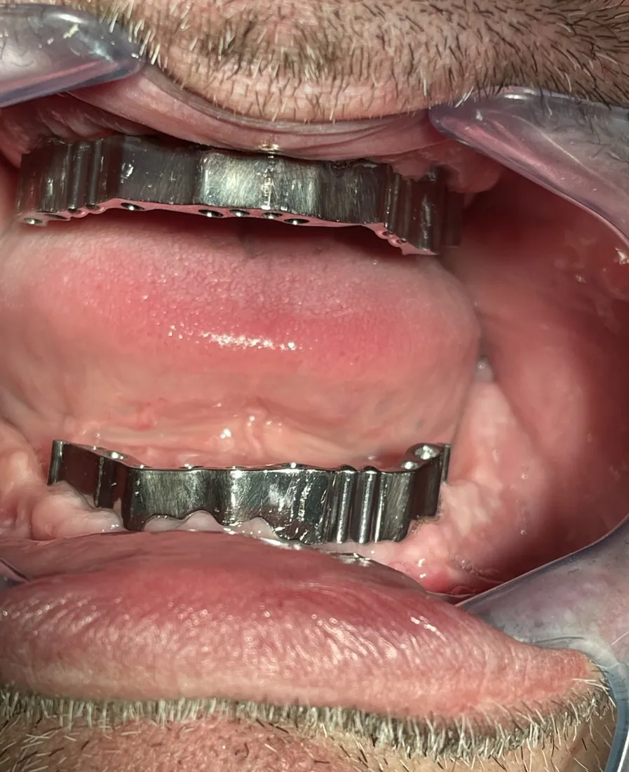 Metallstege auf den Implantaten im Ober- und Unterkiefer