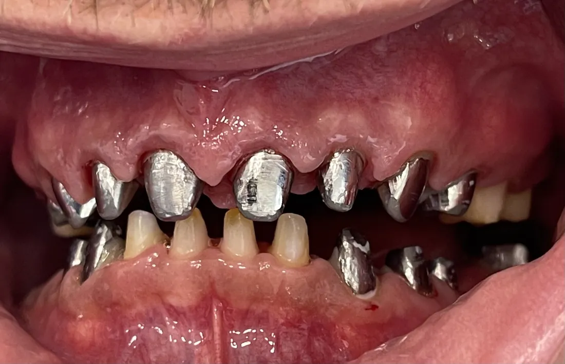 Die eingesetzten gegossenen Stiftaufbauten aus Metall