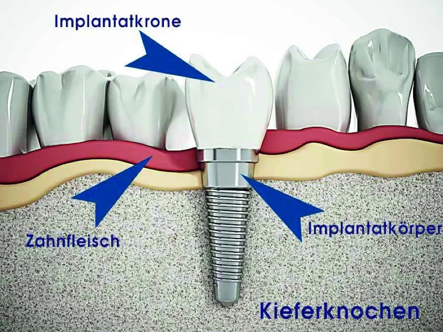 Schema eines Implantats mit Implantatkrone, Zahnfleisch, Implantatkörper und Kieferknochen