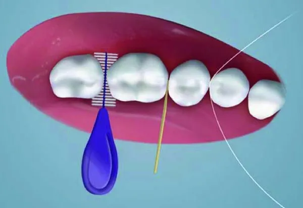 Reinigung der Zahnzwischenräume mit Interdentalbürste und Zahnseide