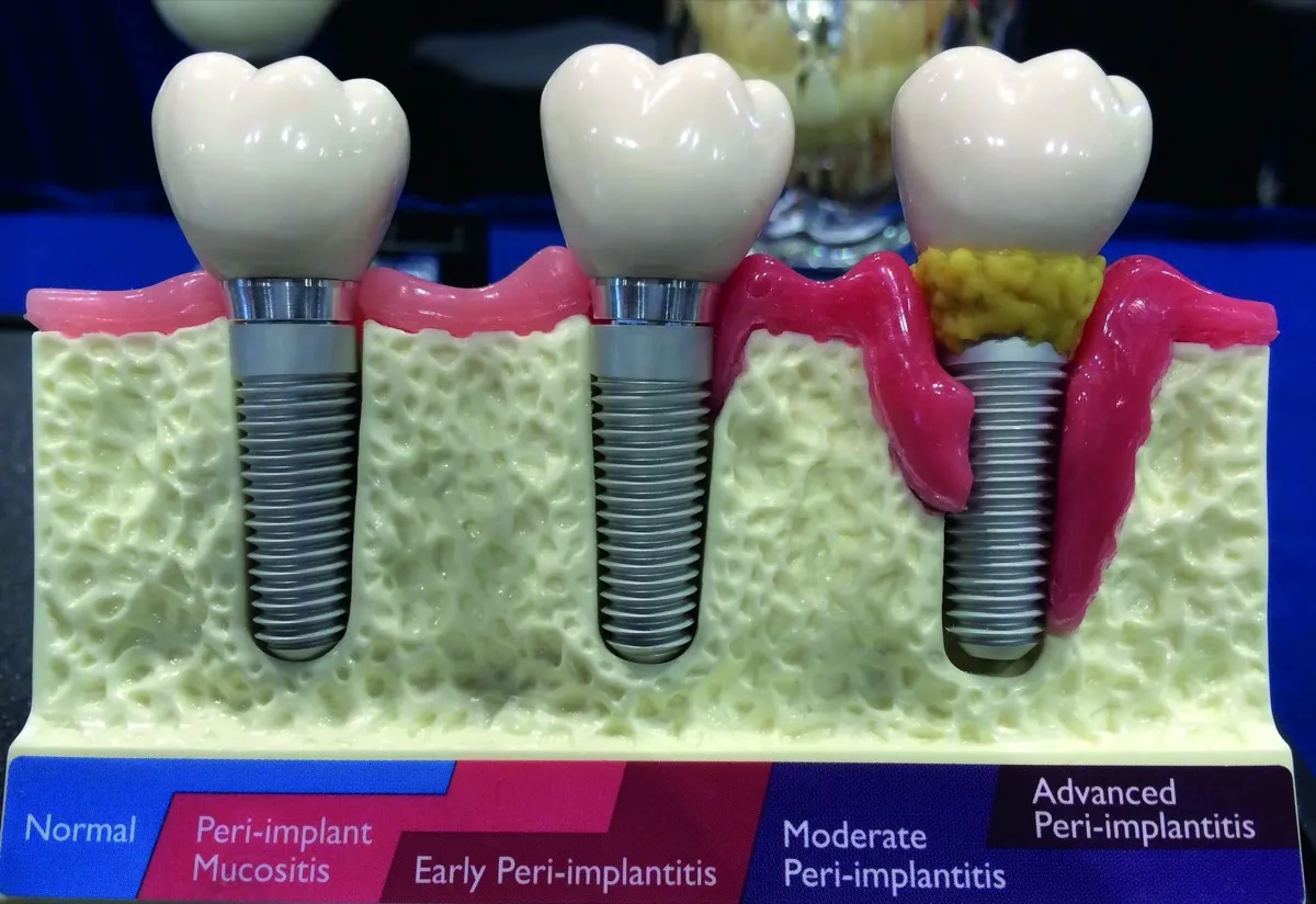Schema: gesundes Implantat, periimplantäre Mukositis und fortschreitende Periimplantitis mit Knochenabbau